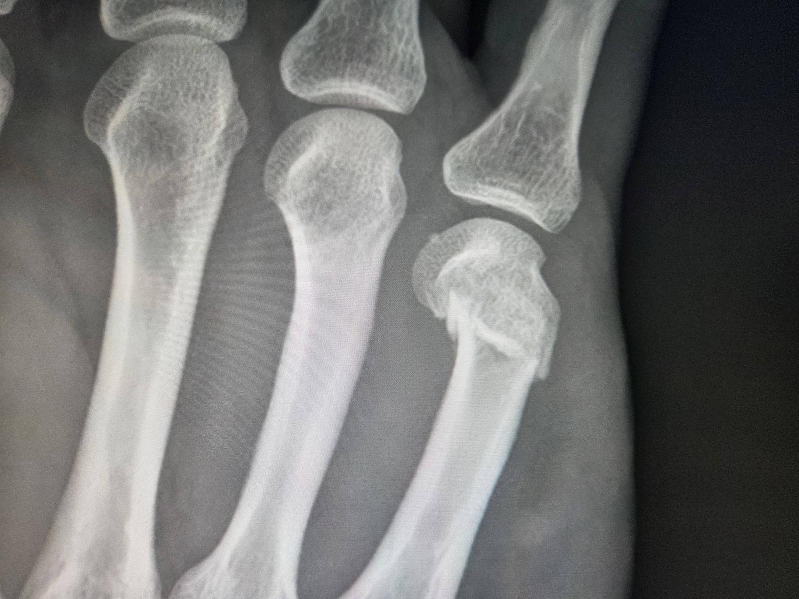 Close-up X-ray photograph showing the joints between the metacarpal bones and finger bones (phalanges) of the hand