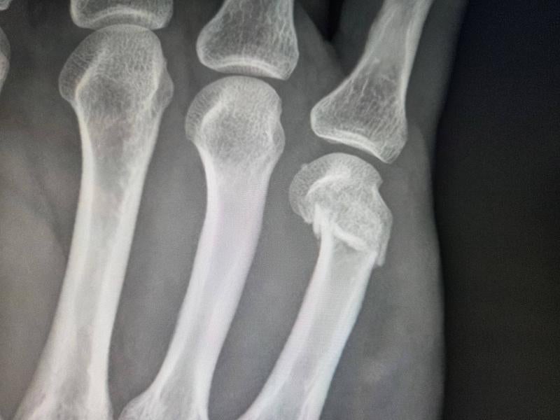 手の骨のレントゲン