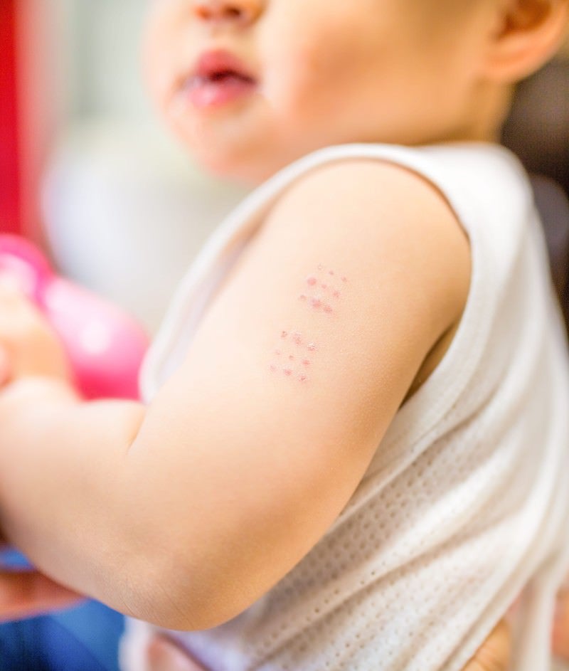 「BCGワクチンの接種痕（赤ちゃんの腕）」の写真［モデル：Lisa］