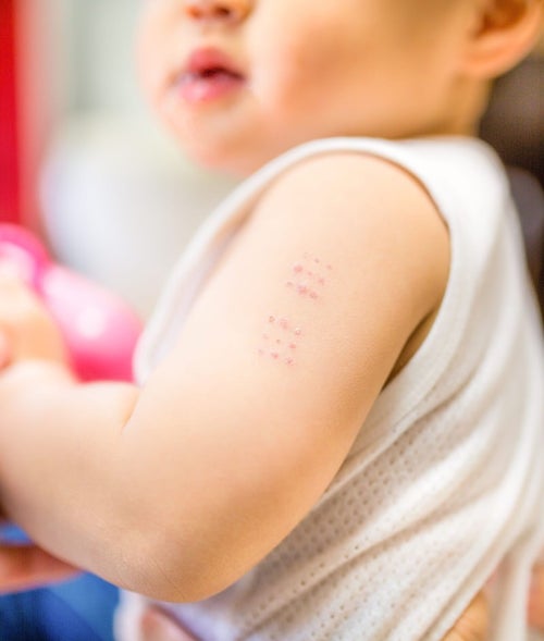BCGワクチンの接種痕（赤ちゃんの腕）の写真