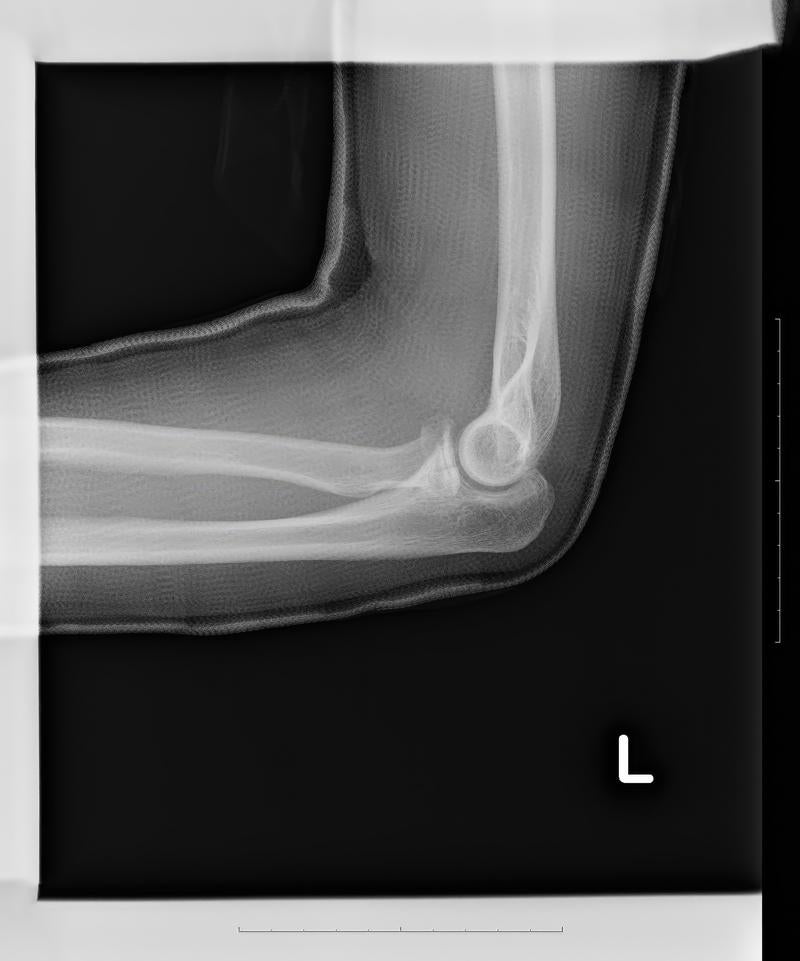 「事故で亀裂骨折した左腕のレントゲン」の写真