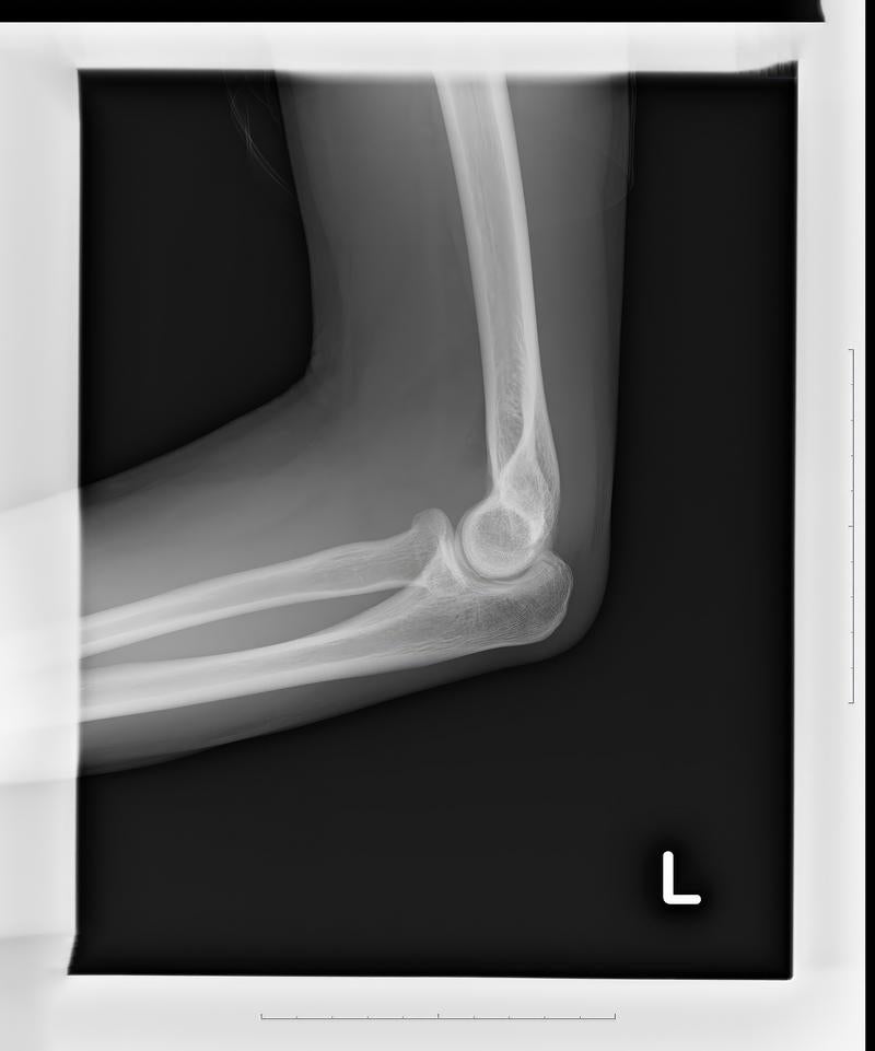 「全治4週間の左腕の亀裂骨折」の写真