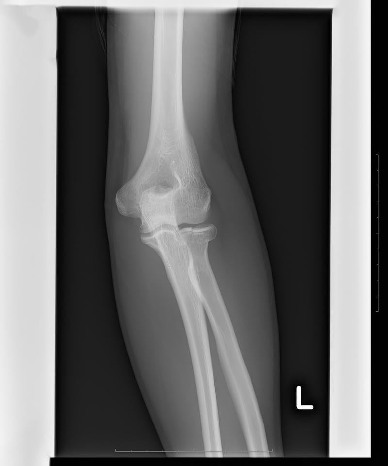 「左足関節部分のレントゲン」の写真
