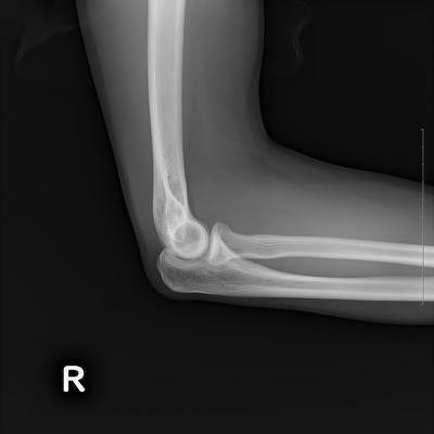 右腕関節のレントゲンの写真