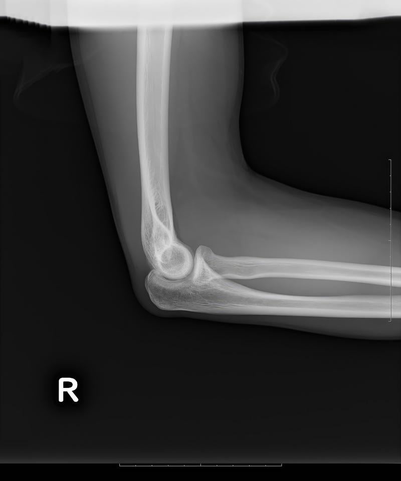 「右腕関節のレントゲン」の写真