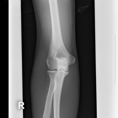 右足関節のレントゲンの写真