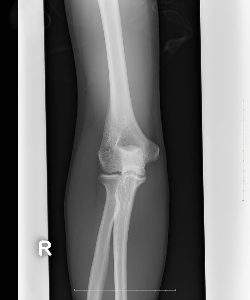 「右足関節のレントゲン」の写真