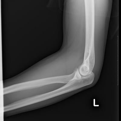 事故で亀裂骨折した左腕（全治4週間）の写真