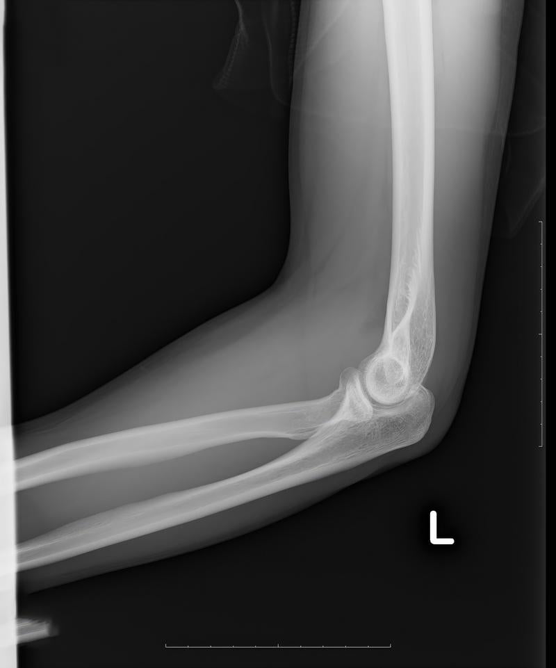 「事故で亀裂骨折した左腕（全治4週間）」の写真