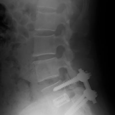 腰部脊柱管狭窄症治療のレントゲンの写真