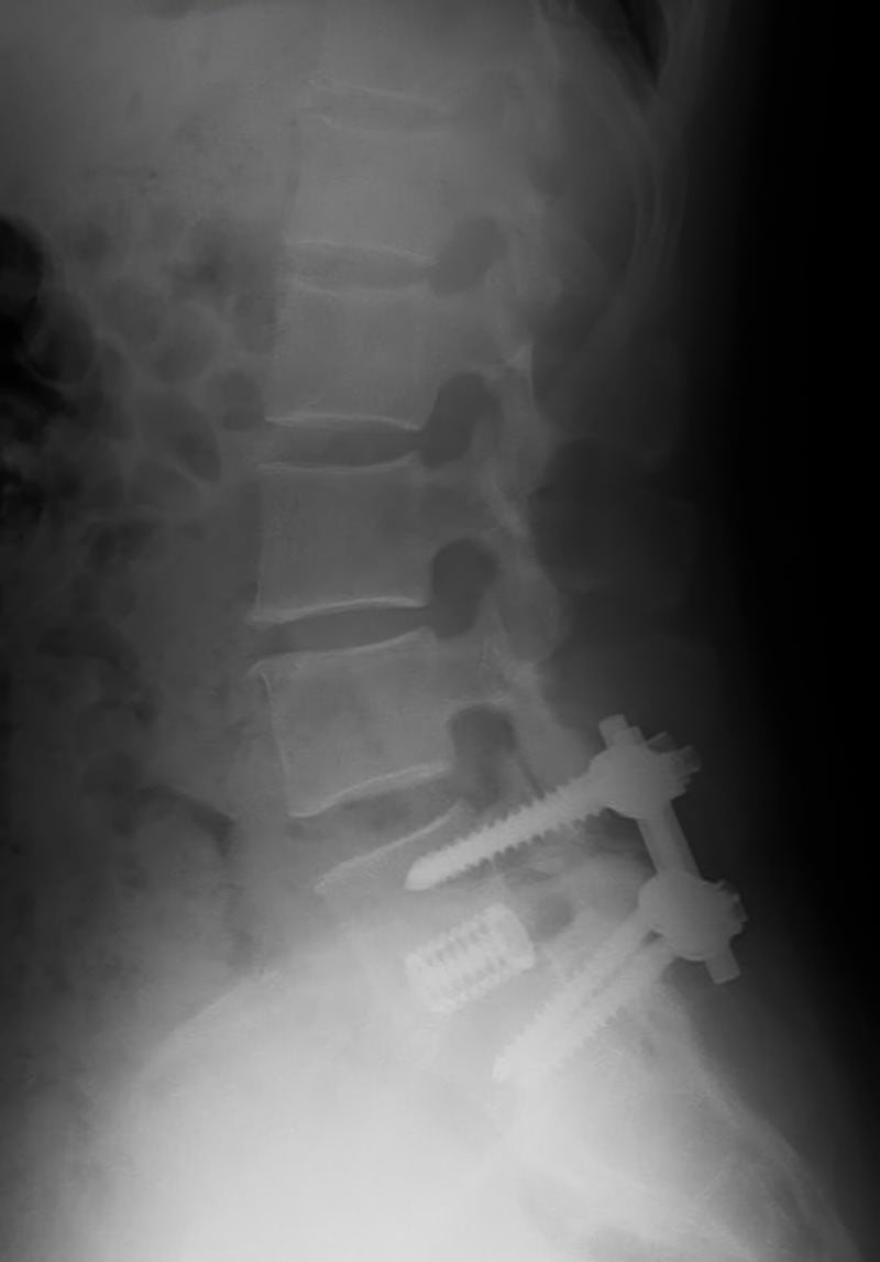腰部脊柱管狭窄症治療のレントゲンの写真