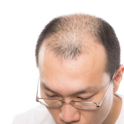 AGA（男性型脱毛症）の男性の写真