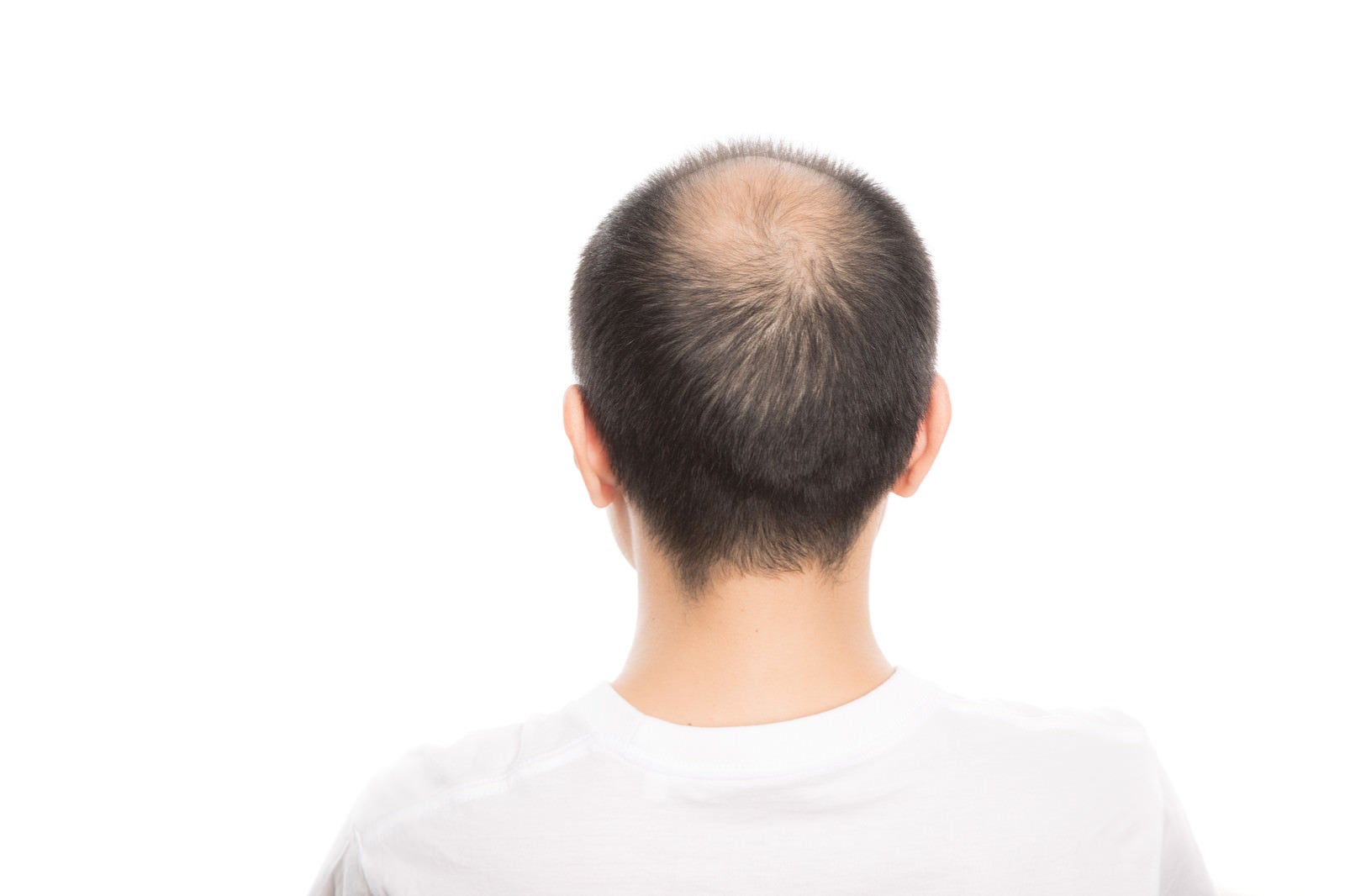 「頭頂部が薄毛（男性型脱毛症）の男性の後ろ姿」の写真［モデル：サンライズ鈴木］