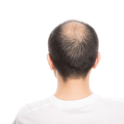 頭頂部が薄毛（男性型脱毛症）の男性の後ろ姿の写真