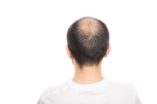 頭頂部が薄毛（男性型脱毛症）の男性の後ろ姿の写真