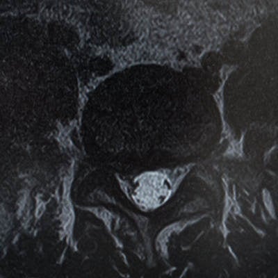 椎間板ヘルニアによって右の神経根が圧迫（MRI輪切り）の写真