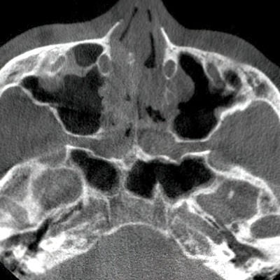 頭部のMRI画像の写真