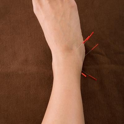 足の甲の鍼治療の写真