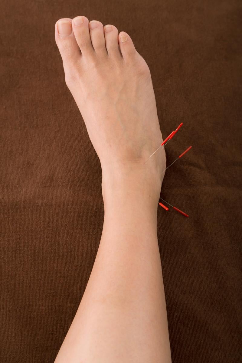 「足の甲の鍼治療」の写真