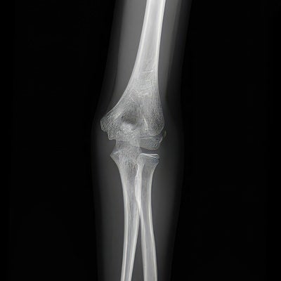左の肘関節（腕尺関節）のレントゲンの写真