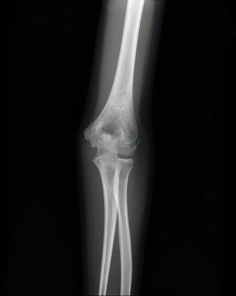 「左の肘関節（腕尺関節）のレントゲン」の写真［モデル：あんじゅ］