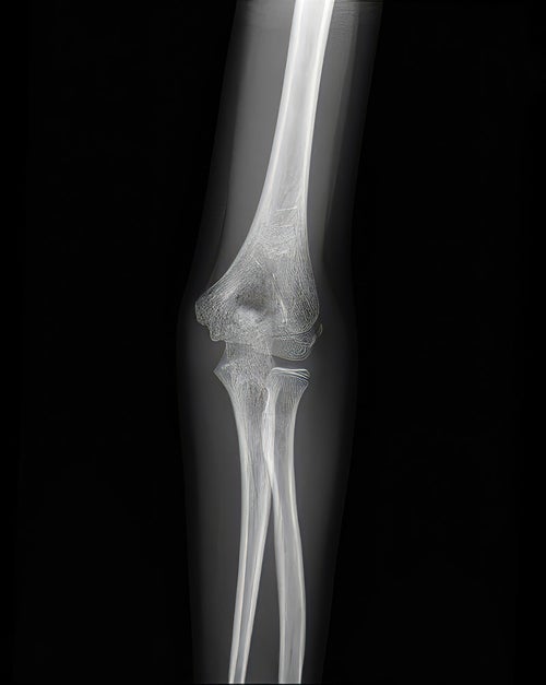 左の肘関節（腕尺関節）のレントゲンの写真