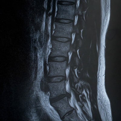 腰椎5番が椎間板ヘルニア（MRI）の写真
