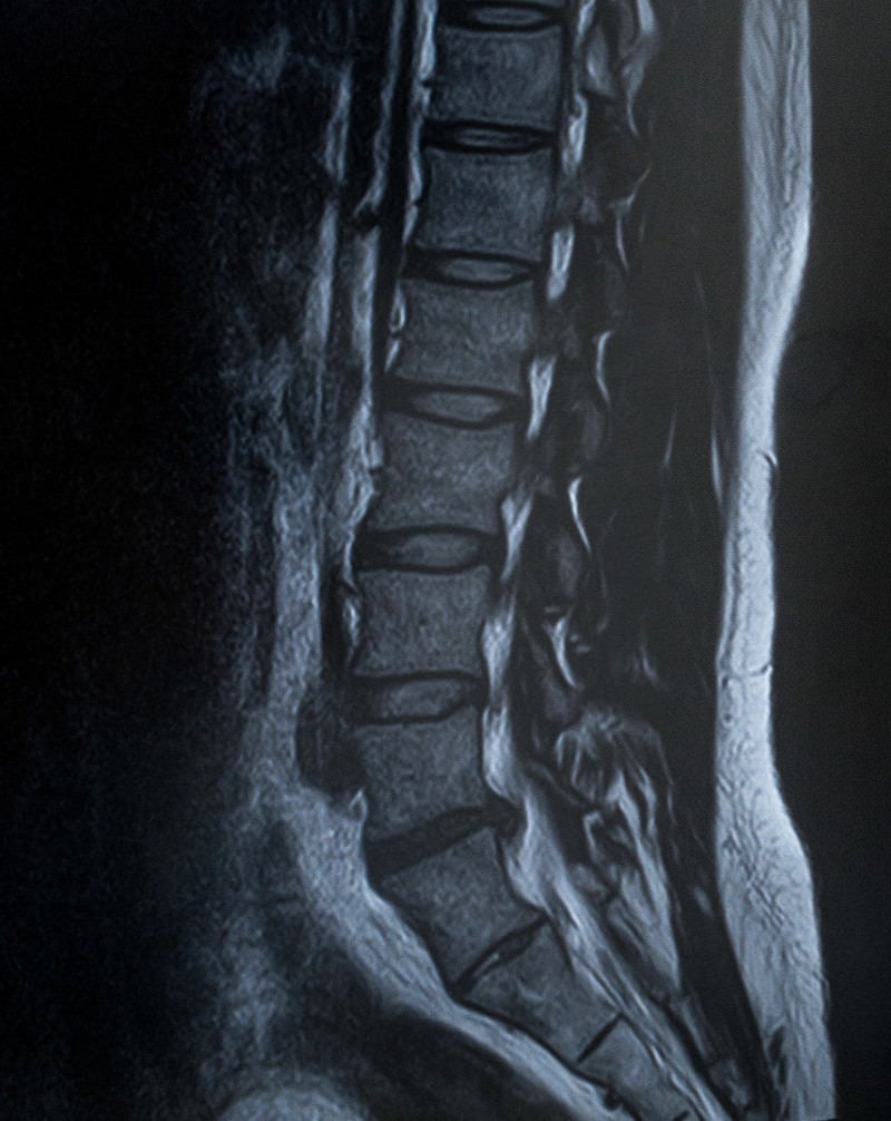 「腰椎5番が椎間板ヘルニア（MRI）」の写真