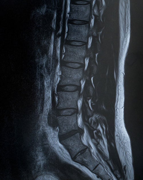 腰椎5番が椎間板ヘルニア（MRI）の写真